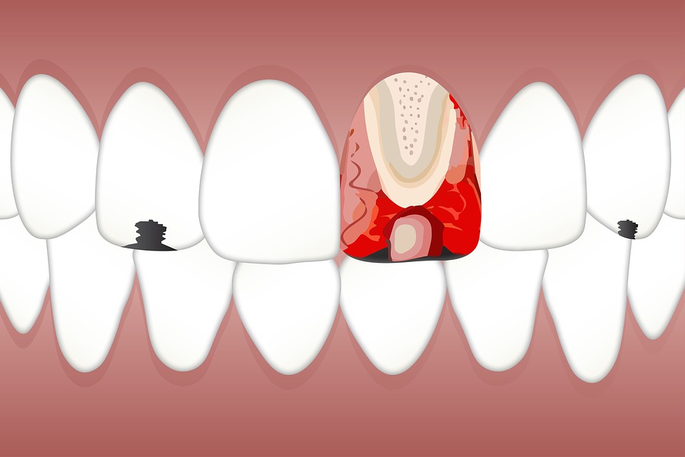 牙周膜细胞中压力诱导的自噬下调牙齿移动过程中的破骨细胞生成