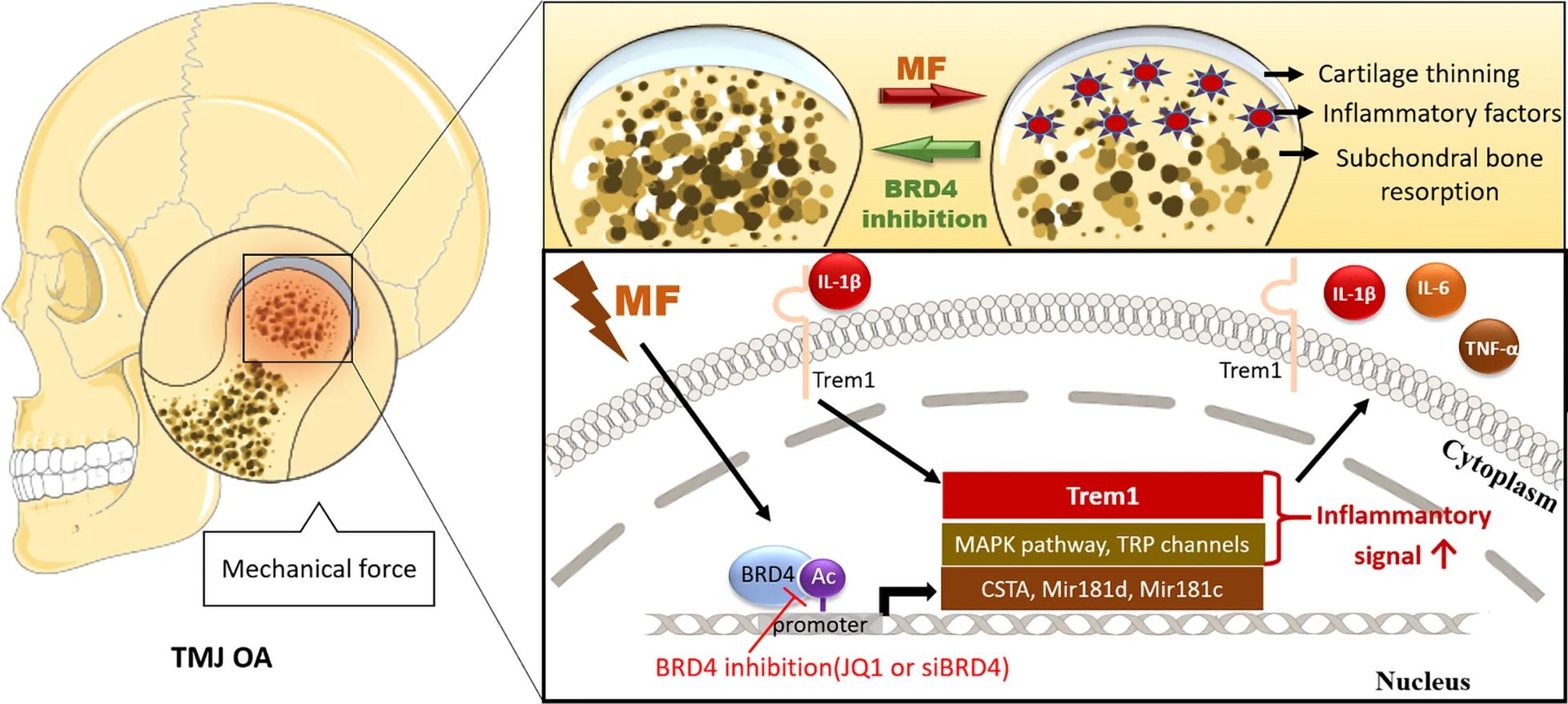 抑制BRD4减轻机械应力诱导的TMJ OA样病理变化，并减弱TREM1介导的炎症反应